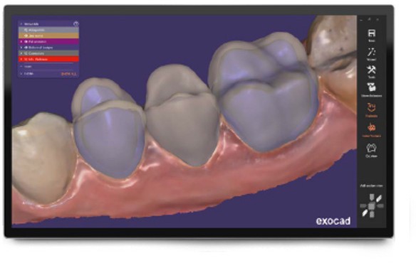 Exocad Official Reseller