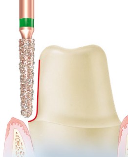 Komet+DIAO+Round+Short+Tapered+Chamfer+Diamond+5pk